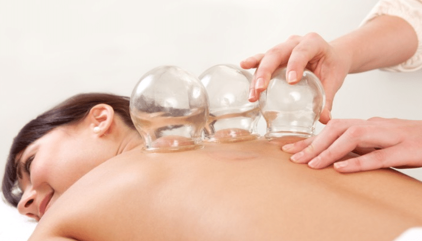 Cupping Therapy in Beverly Hills